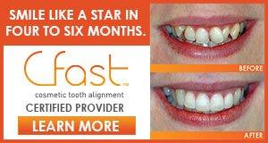 cosmetic tooth alignment