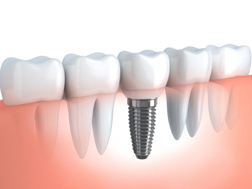 Dental Implant in Sugar Grove IL