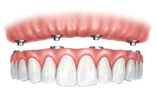 Implant supported Denture, All-on-4, Fixed Denture