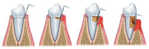 Gum Treatment in Sugar Grove