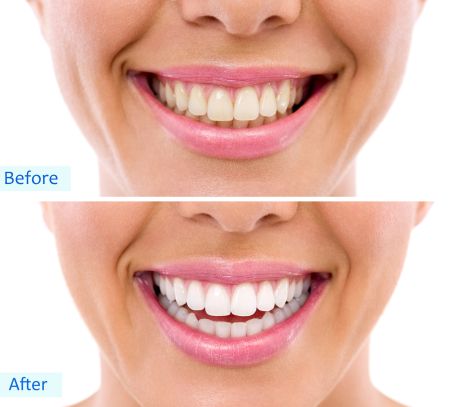 Sugar Grove dentist offers teeth whitening